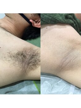 メンズサロンエヌエー(MEN'S SALON NA)/【腕まるごと脱毛】