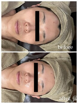 ジャスミン(Jasmin)/臍帯血幹細胞×AC-11×NMN