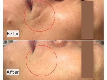 プレジール(Plaisir)/50代ほうれい線、キメ改善