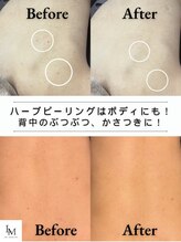 ベル 蒲田(Belle) 夏前！背中 ニキビケア