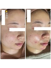 アルムダアクア 天王寺店(Aleumda AQUA)/ハーブピーリング/大阪/天王寺