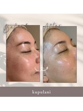 クプラニ 美浜店(kupulani)/プラピールbefore & after