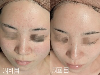 ウィハナ(wehana)/【セラピール】ニキビ/赤み