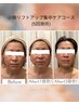 【初回・オプション込】人気No.1美顔コース 小顔リフトアップ集中ケア 100分