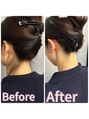 アルムボーテ 代官山 恵比寿(ARUIM Beaute)&nbsp;うなじのビフォーアフター。