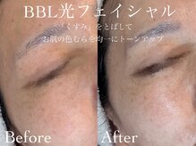 ルチーレ(Lucire)/BBL光フェイシャル