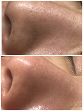 ポマイカイ 名古屋丸の内店(pomaikai)/ハイドロフェイシャル