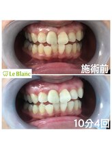 ルブラン 奈良店(Le Blanc)/10分4回照射でトーンアップ！