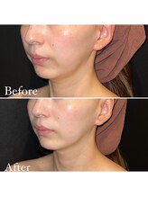 ミエル 神戸店(Miel)/HIRFWAVEハイアールエフウェーブ