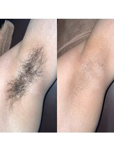 シャイニースキン(Shiny skin)/ワキ脱毛の効果