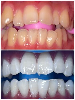 ペルラメディカルホワイトニング 名古屋/一目瞭然