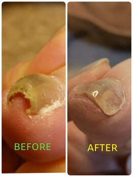 フットスタジオ アルク(FOOT STUDIO ALUK)/【巻き爪補正ペディグラス】