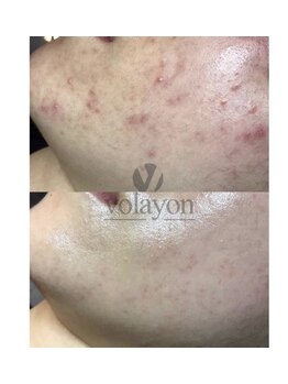 ジュエッテ(jouete)/volayon