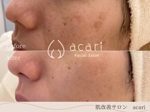 アカリ(acari)の雰囲気（結果重視の商材を使用～肌改善を目指していきます！～）