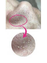 カンパニュラ(campanula)/#毛穴エクストラクション