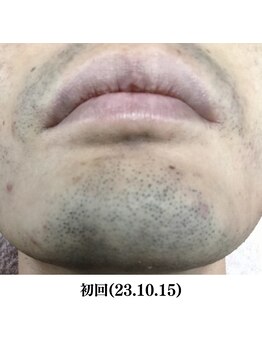レイ(R.E.I)/【脱毛ビフォー】口周り