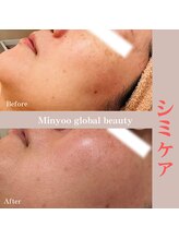 ミニョ コリアンビューティー(Minyoo korean beauty)/症例写真/乾燥、シミケア