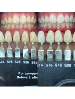 トウキョウスワーズ 池袋店(TOKYO SWRS)/#ホワイトニング #池袋 #渋谷
