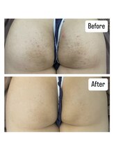 エミルカ 新宿(EMILUCA)/お尻もツルツルに