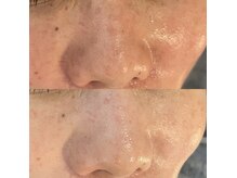 グレアージュ(GLEAGE)/たるみケア エイジングコース！