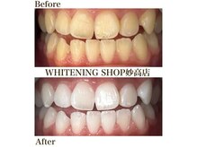 ホワイトニングショップ 妙高店(whiteningshop)の雰囲気（お悩みに寄り添う丁寧なカウンセリングで無理な勧誘はなし♪）