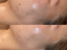 ビジュープラス 広島店(Bijou+)/【20代/ニキビケア】