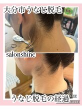 サロンシャイン(Salon Shine)/うなじ脱毛