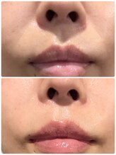 アンフェム(Anfem)/水光ボツリヌスフェイシャル