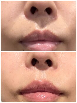 アンフェム(Anfem)/水光ボツリヌスフェイシャル