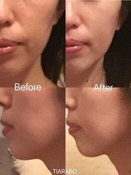ティアラボ(TIARABO)/小顔リンパ&高保湿パック