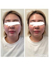 ケアラボ(Care Labo)/【FN美容鍼】