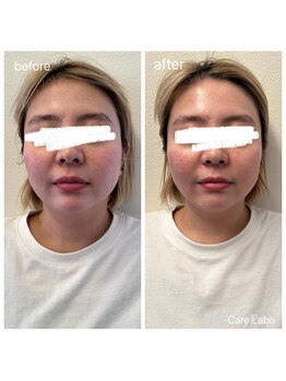 ケアラボ(Care Labo)/【FN美容鍼】