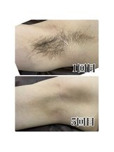 エース 赤坂/わき脱毛５回目の症例