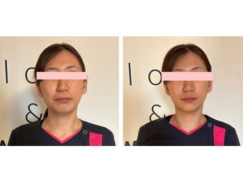 ヨサパーク リアン(YOSA PARK Lien)/モニター様before→after/痩身