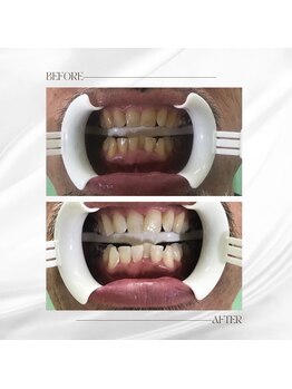 ホワイトニングセンター 大阪羽曳野店/歯科提携ホワイトニング症例