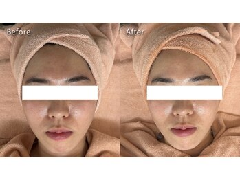 ミュー 春日井店(mieux)/◆肌質改善例