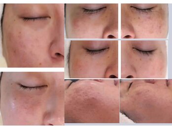 リジュベネーションサロン アリス(Alice)/ガリレオピーリングB＆A