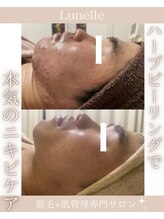 ルネル(Lunelle)/本気のニキビケア☆