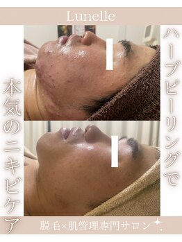 ルネル(Lunelle)/本気のニキビケア☆