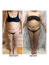 ラニ(LANI)/キャビテーション