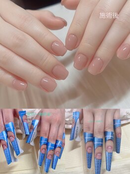 ユーネイル(You nail)/深爪矯正