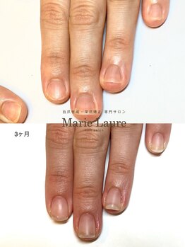 マリーロール 梅田店(Marie Laure)/自爪育成/深爪矯正/ネイルケア