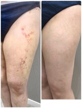 ベルネ(BELLUNE)/術後ケアにはラジオ波が◎