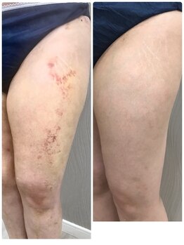 ベルネ(BELLUNE)/術後ケアにはラジオ波が◎