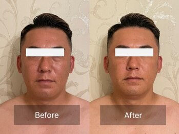 エーアイビューティー 柏店(Ai Beauty)/ 【フェイシャル例】