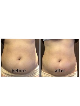 ワールドアイ(World. I)/脂肪冷却