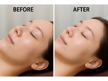 ニコリー(nicoly)/イオン導入◎before→after