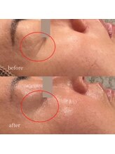 アーネスト 大阪心斎橋店(EARNEST)/韓国式光美容【 目の横しわ 】