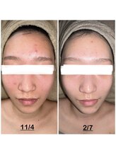 ミニョン(mignon)/モニター結果