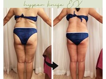 リヘッド(Re.head)/ハイパーナイフEX ウエスト集中